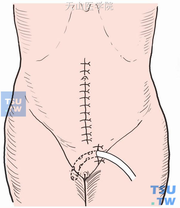 引流管由腹部切口下端引出