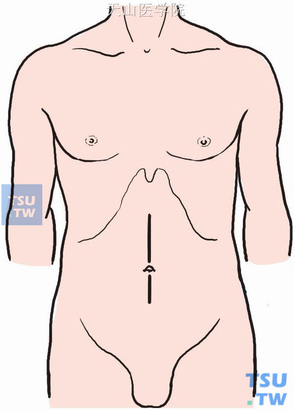 取中上腹正中切口或右侧旁正中切口进腹。探查胃肠道、肝脏、盆腔、肠系膜根部等部位，以了解有无癌肿种植或转移。最后轻巧地检查肿瘤大小、质地、活动度等