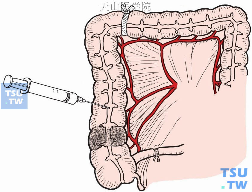 纱带阻断肠腔，经结肠带穿刺注射5-氟尿嘧啶