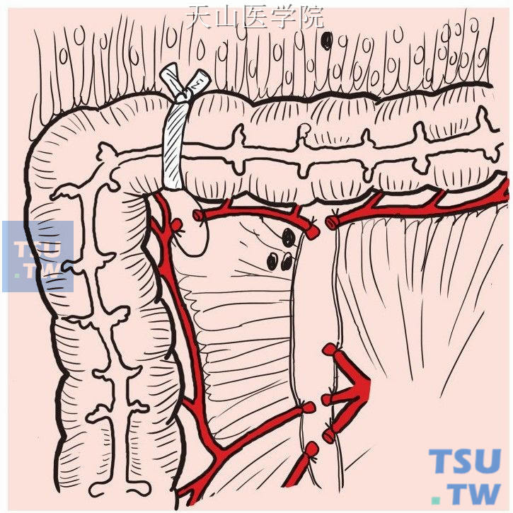 结肠中动脉起始部结扎切断右支