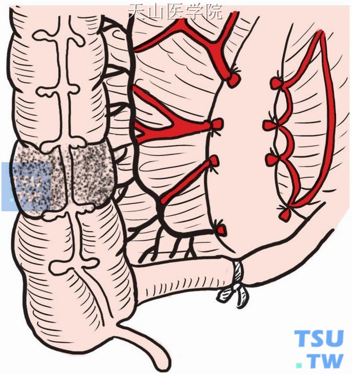 右结肠、回结肠血管在起始部逐一结扎切断