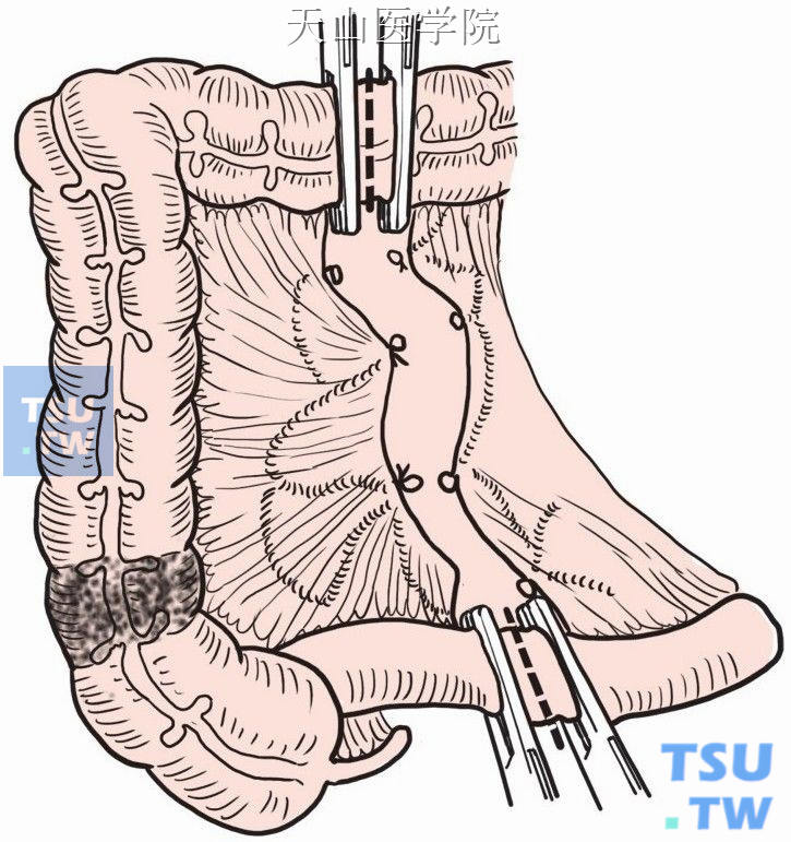 横结肠中段及末段回肠钳夹切断