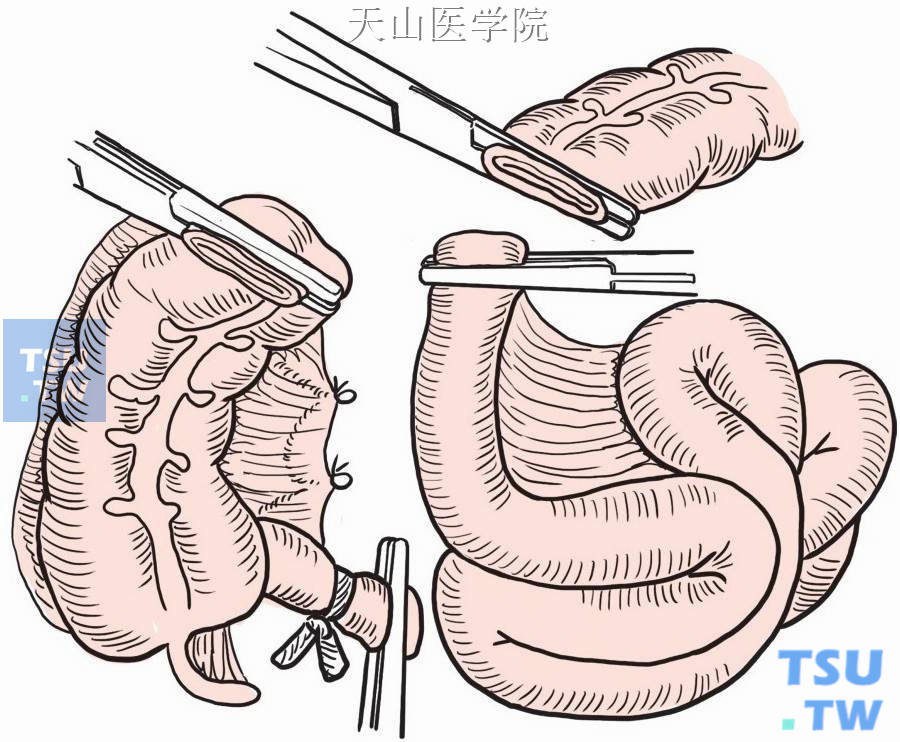 将癌肿肠段连同大网膜、腹膜后淋巴结脂肪组织做整块切除