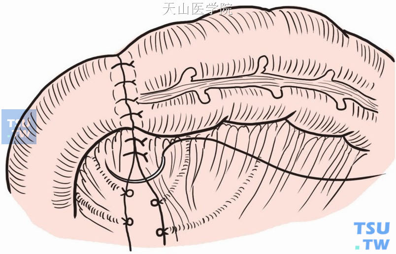 间断缝闭肠系膜裂孔