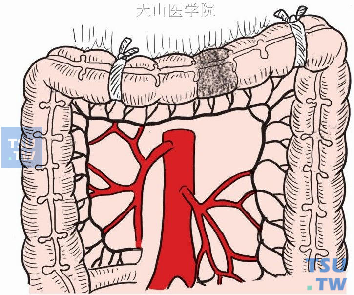 近结肠肝曲、脾曲处用纱带结扎