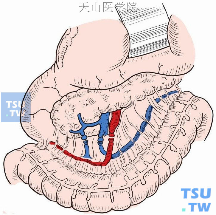 于结肠中动（静）脉起始部结扎、切断