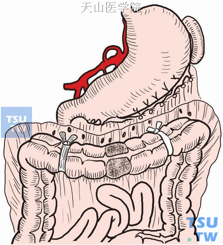 切断脾结肠和肝结肠韧带，打开降、升结肠近、远端侧腹膜