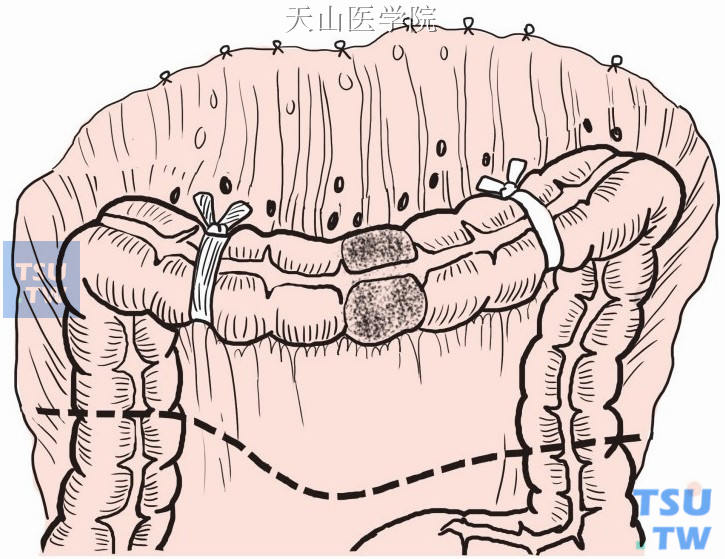 分别于肝曲近侧和脾曲远侧切断结肠