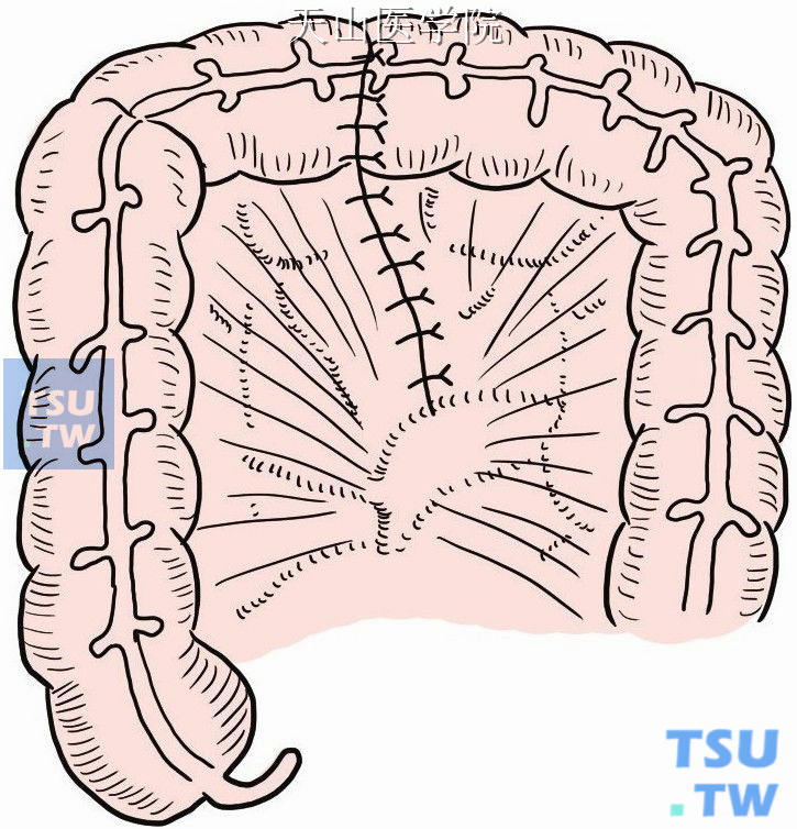 结肠端端吻合，肠系膜裂孔缝合关闭