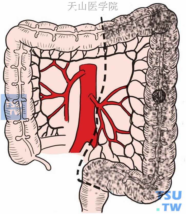 降结肠处肿瘤和切除范围