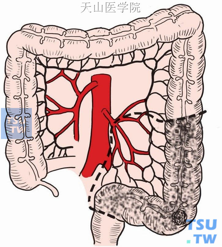 乙状结肠处肿瘤和切除范围