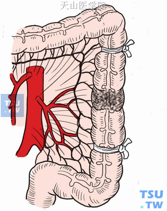 纱带结扎阻断肿瘤两端肠腔