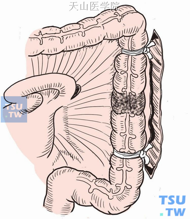 左半结肠癌手术步骤图图片
