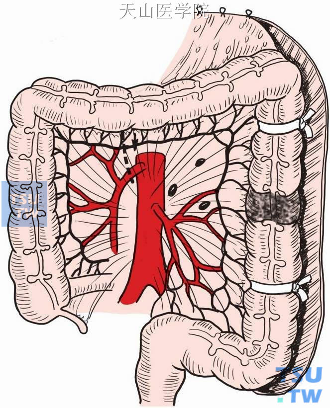 结肠中动脉起始部结扎切断