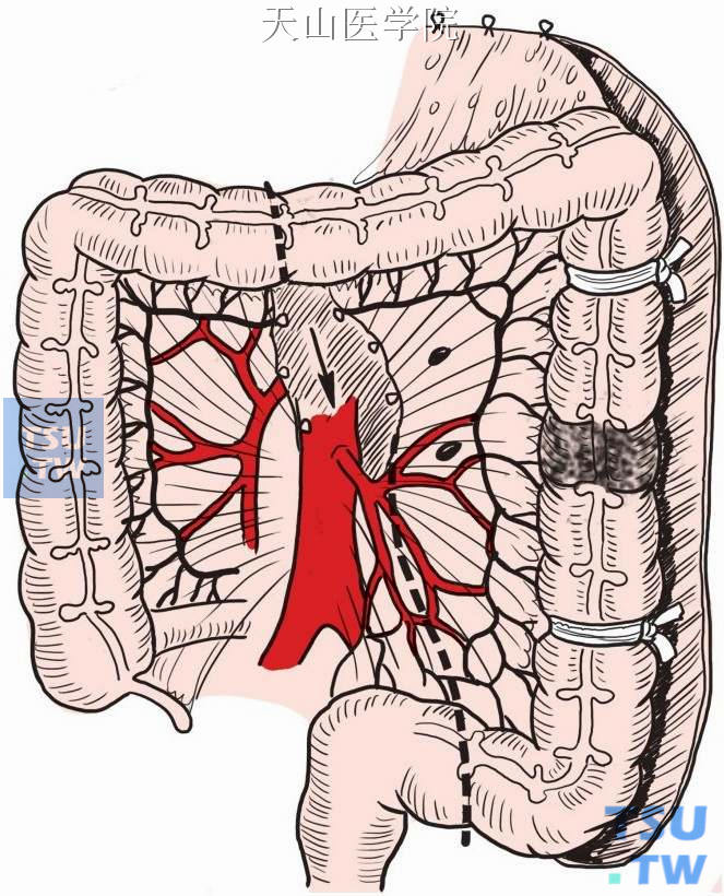 肠系膜下血管根部离断左结肠血管