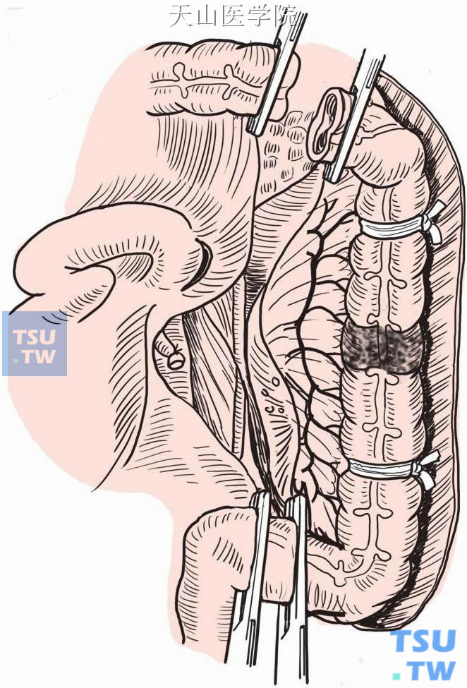 在近、远切除部位各置两把有齿血管钳，钳间切断肠管，将肿瘤肠段连同大网膜、腹膜后淋巴结脂肪组织做整块切除