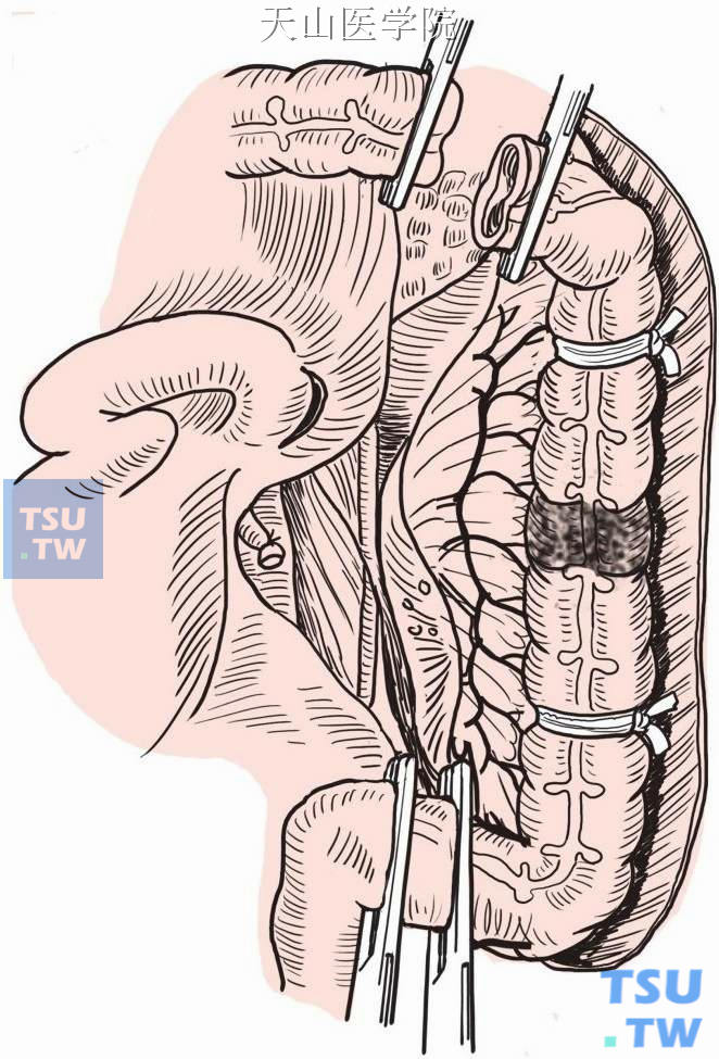左半结肠癌手术步骤图图片