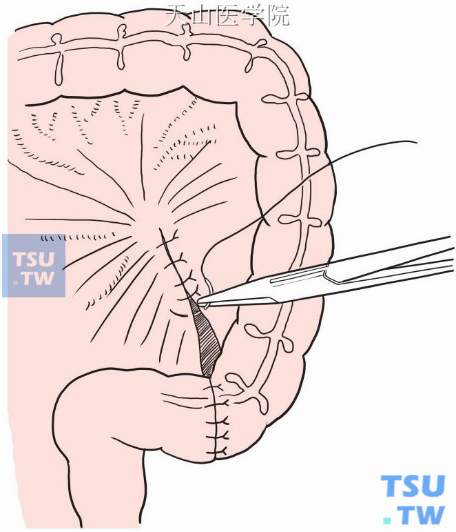 横结肠乙状结肠端端吻合，结肠系膜裂隙缝合关闭