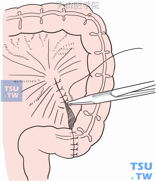 左半结肠癌手术步骤图图片