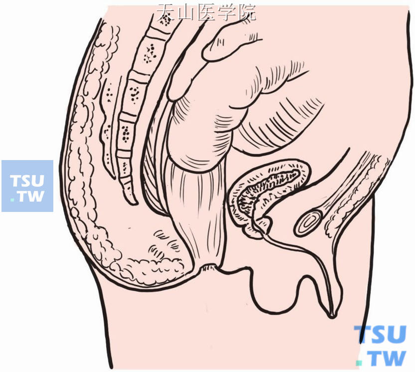 直肠膀胱陷凹解剖图图片