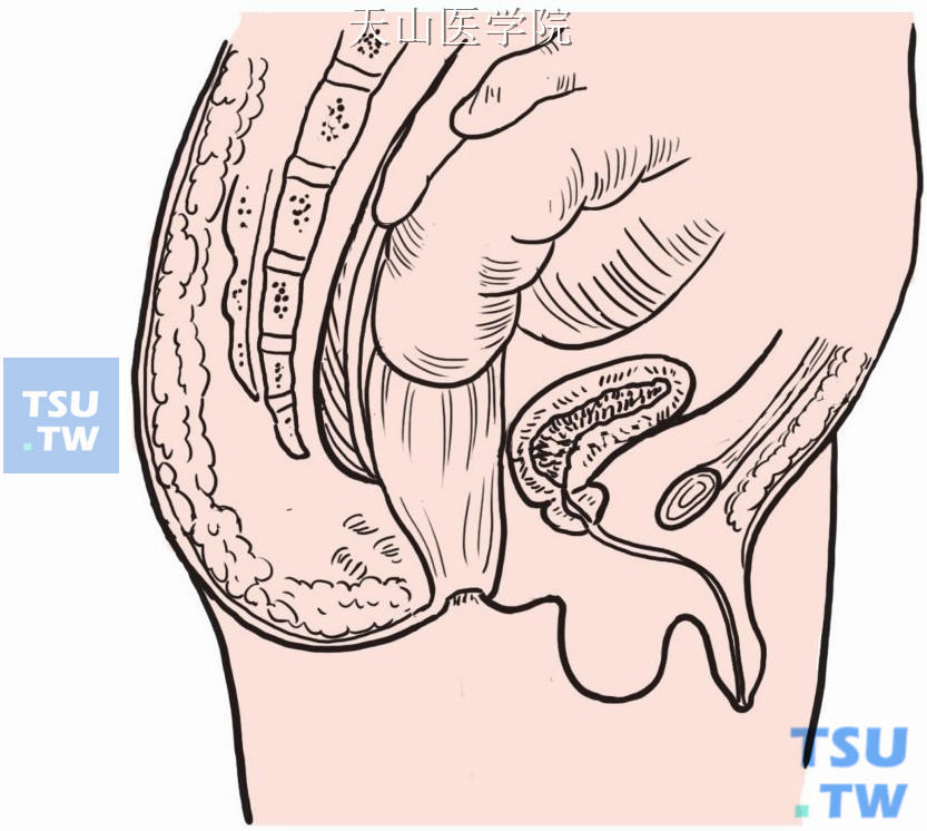 紧贴直肠背侧分离直肠至盆底、尾骨尖平面