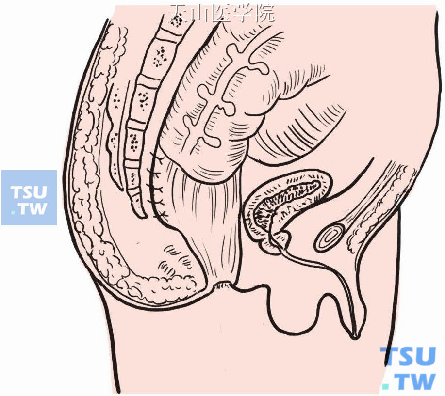 直肠缝合固定在骶岬平面的骶前筋膜和骨膜上