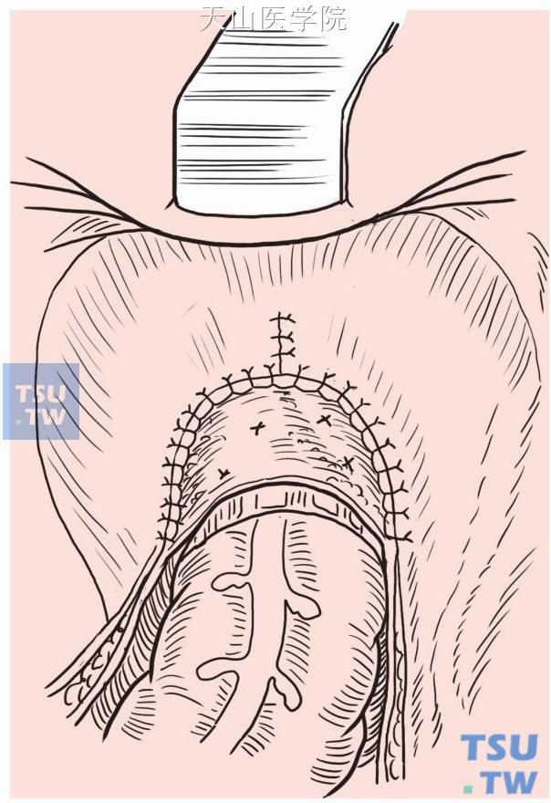 缝合盆底腹膜，缝闭乙状结肠系膜与后腹膜间隙