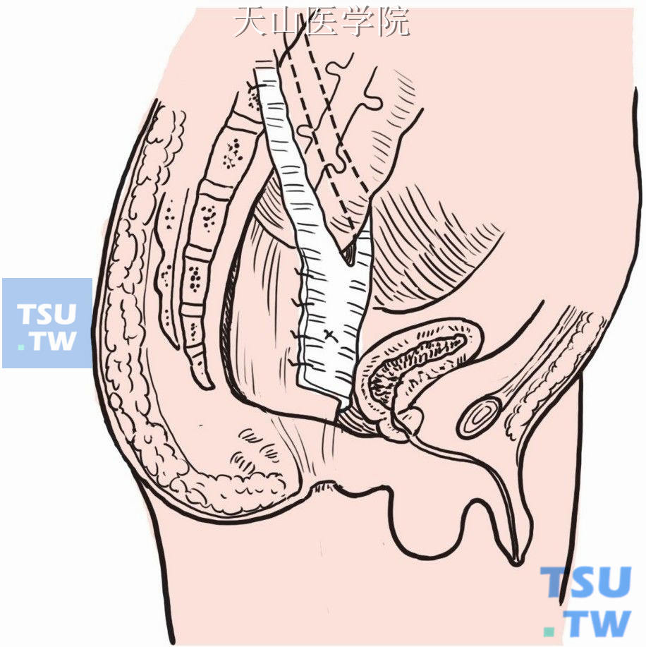 人造血管剖开后成“人”字形，倒置包裹与直肠缝合固定