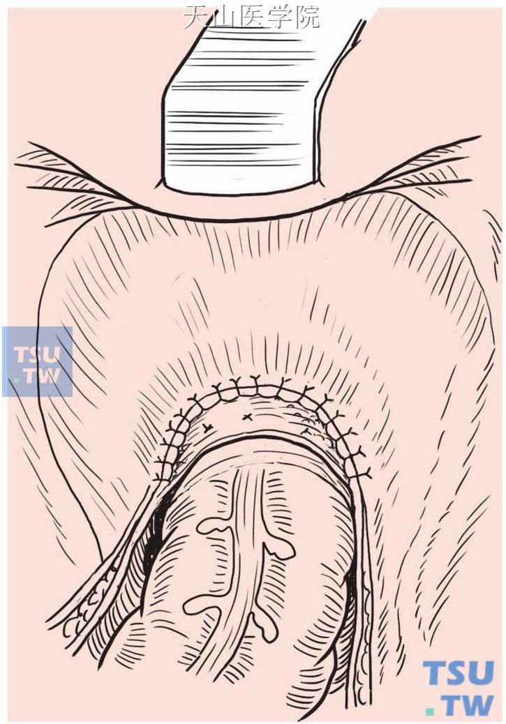 缝合盆底腹膜，缝闭乙状结肠系膜与后腹膜裂隙