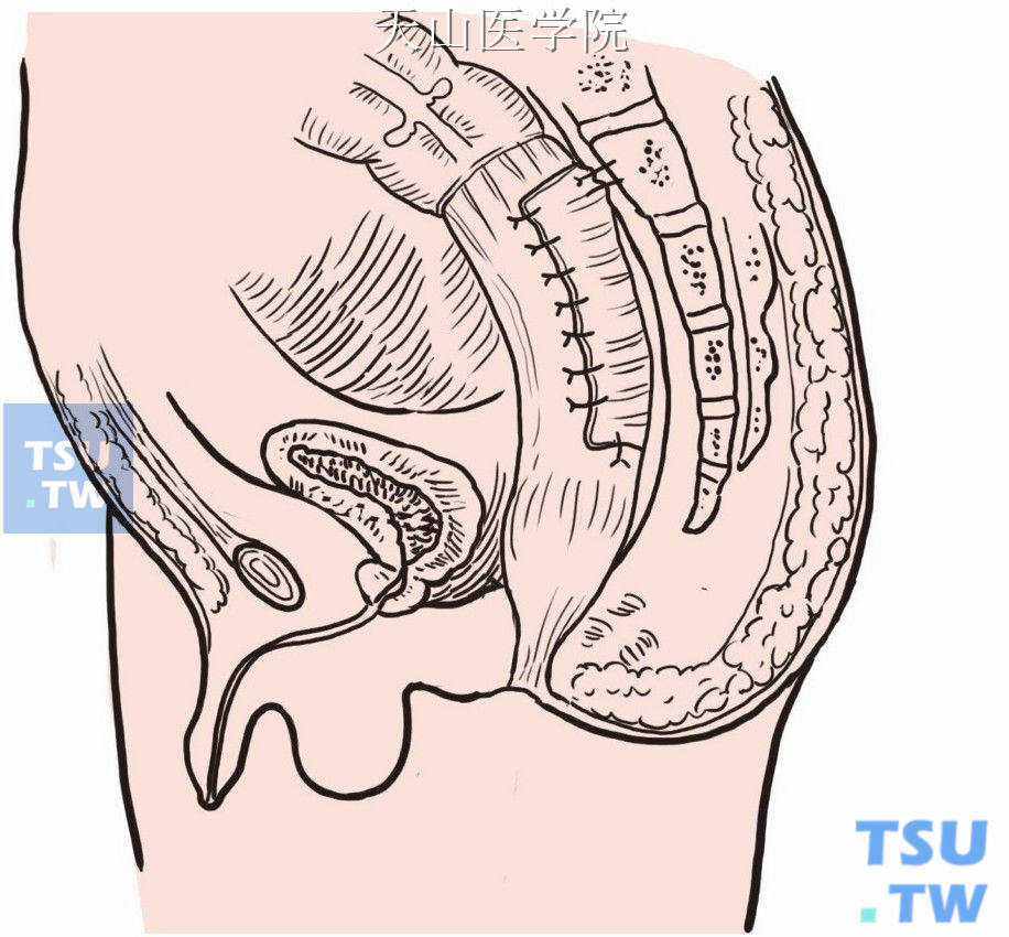 扩大的直肠悬吊固定术