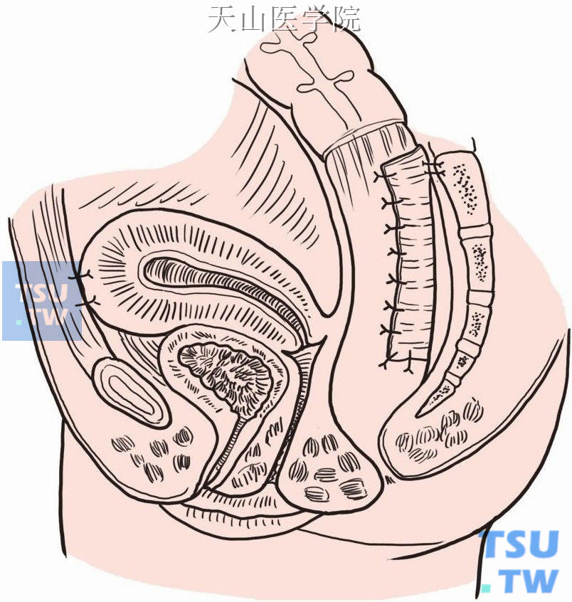 子宫底缝吊固定于前腹壁