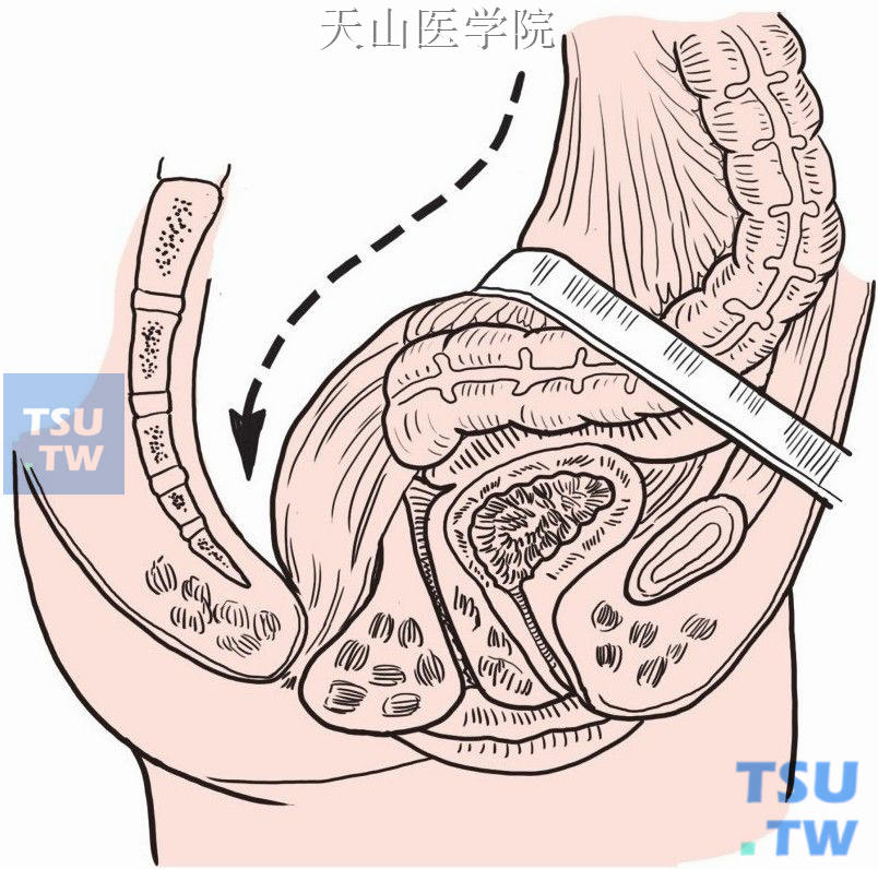 直肠后方骶前间隙锐性游离至盆底