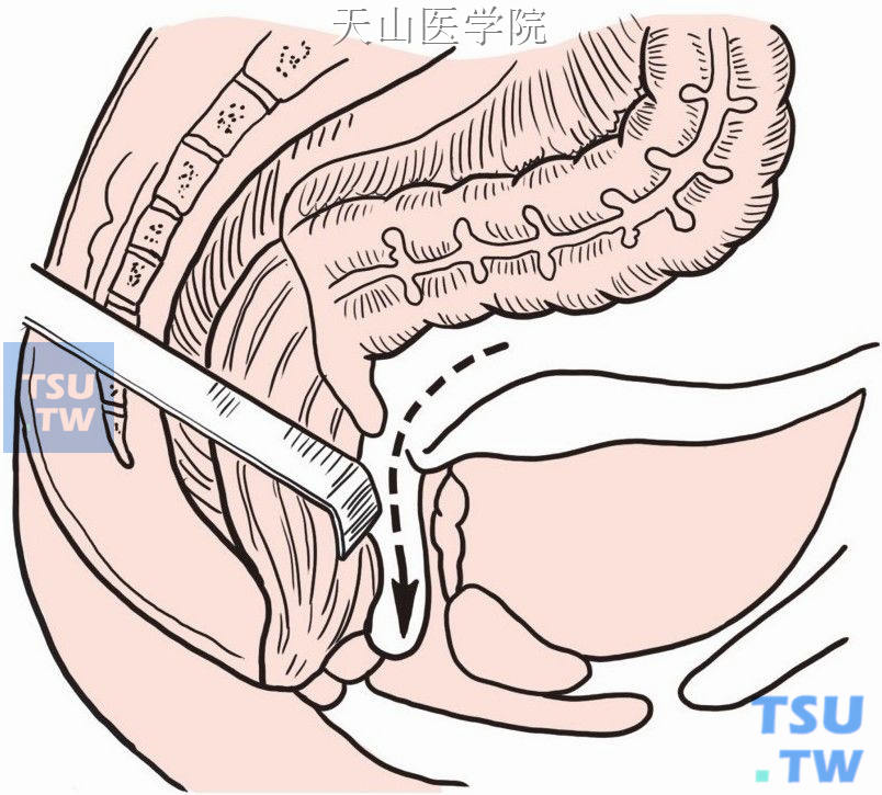 直肠前方于直肠膀胱陷凹切开或直肠子宫陷凹间分离