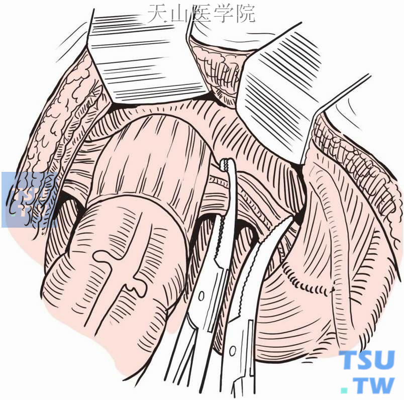 直肠两侧侧韧带紧贴盆壁予以切断
