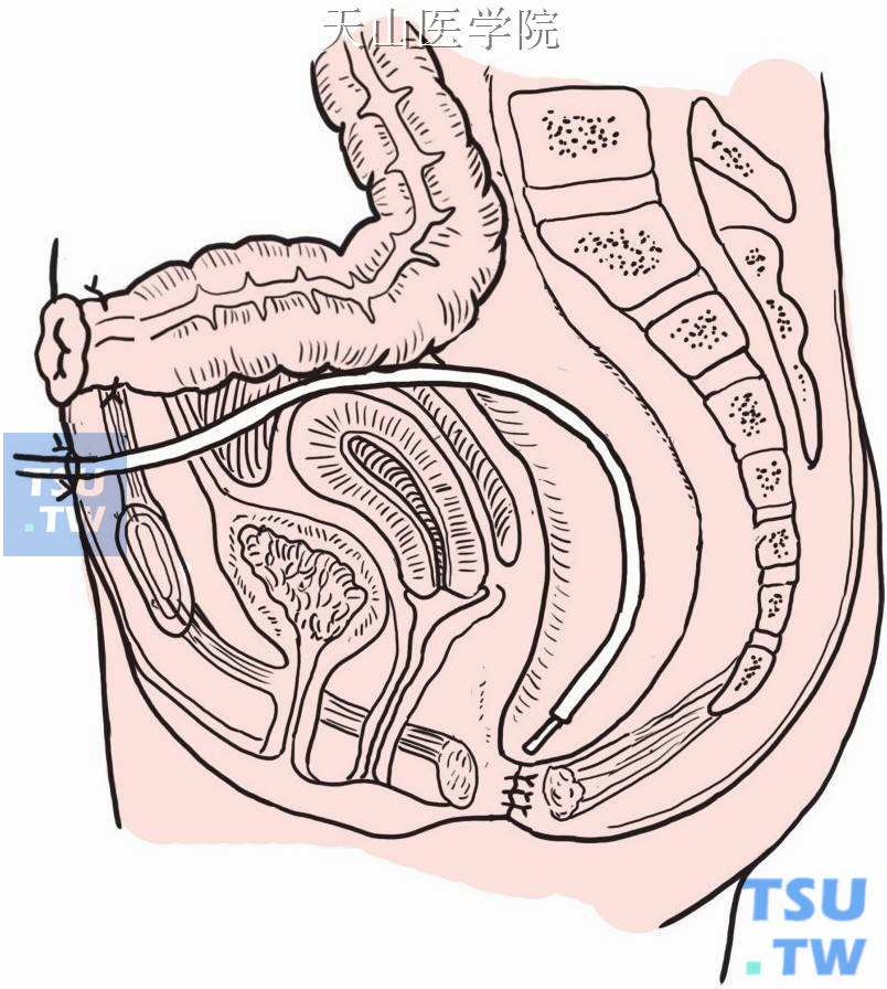盆腔内留置引流管自腹部切口下端引出