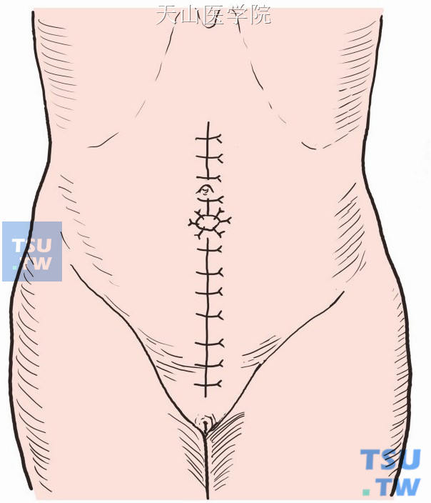乙状结肠近端自切口上端脐下2～3cm处引出