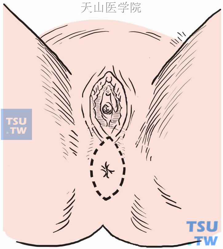 会阴部切口