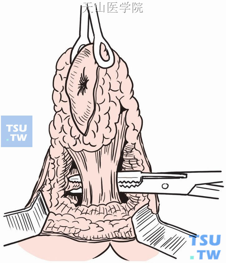 切开肛尾韧带进入盆腔