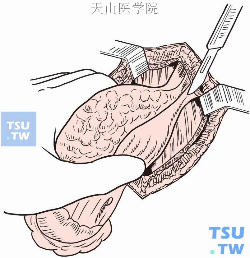 直肠前壁分离，完成直肠肛管的游离