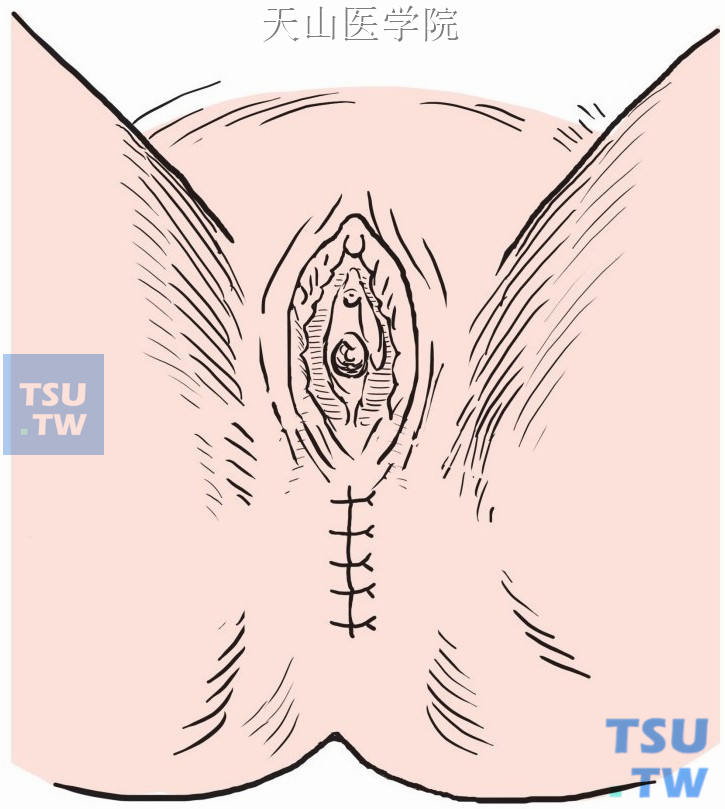 会阴部切口示意图