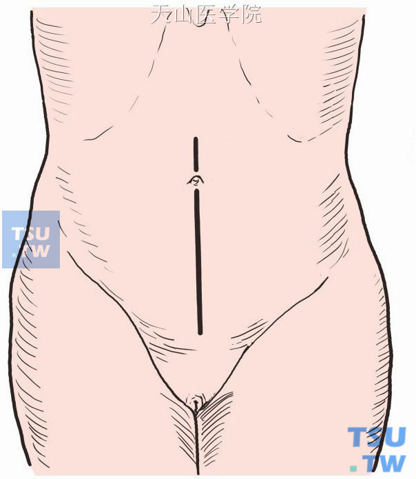 取下腹部正中切口，自耻骨联合至脐上4cm