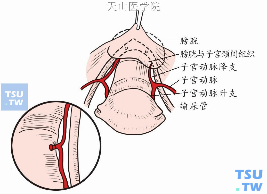 子宫动（静）脉处理