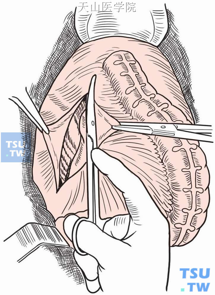 两侧后腹膜切开向前下方延伸至直肠子宫陷凹腹膜返折上