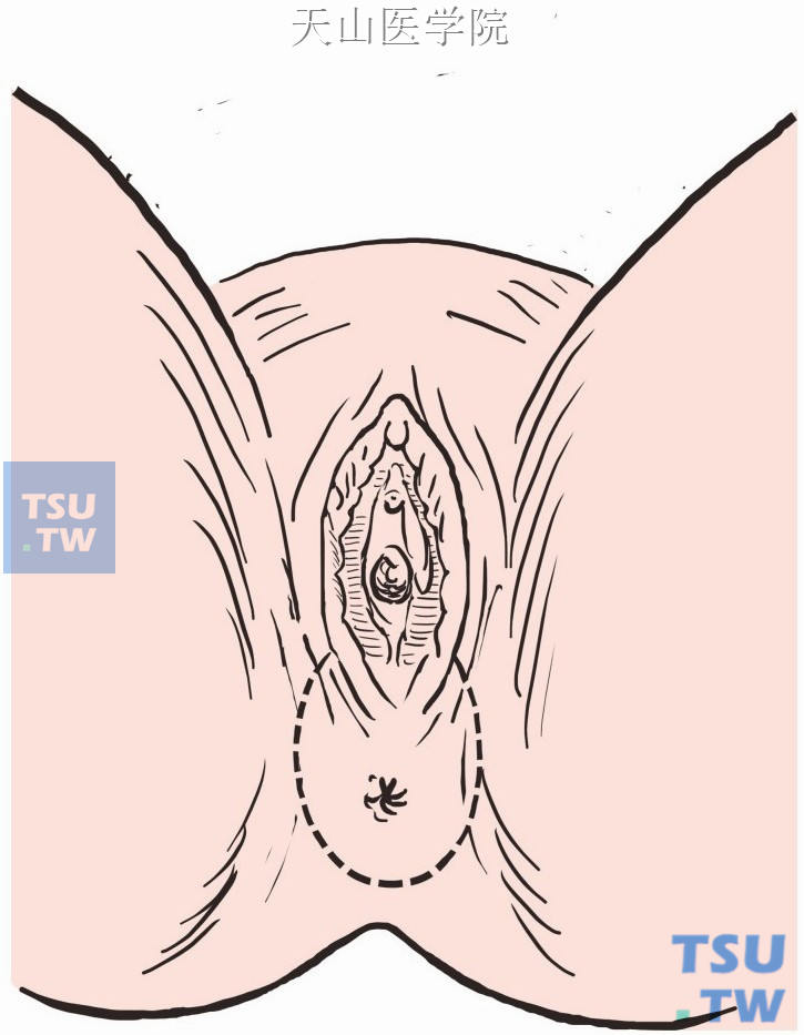 缝闭肛门，会阴部梭形切口，前起自阴道口两侧之中点，后止于尾骨尖，两侧在坐骨结节内侧，距肛缘2cm