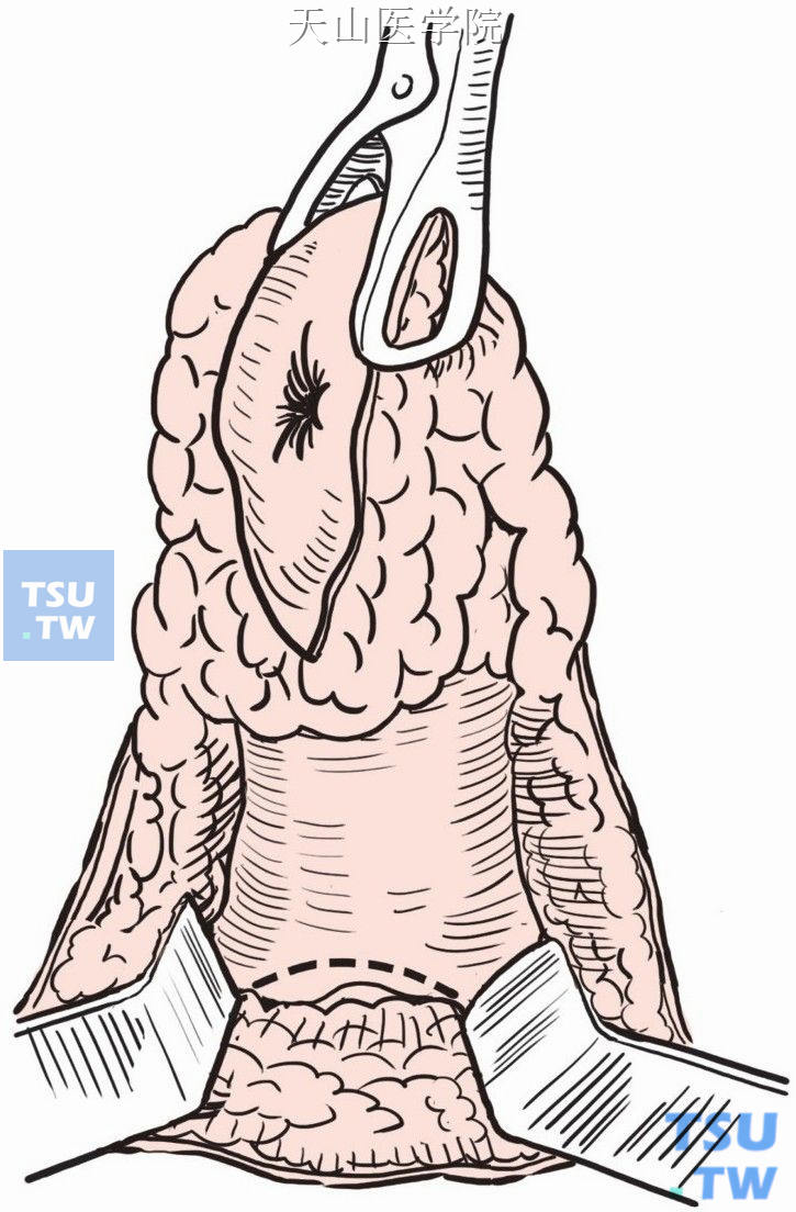切断肛尾韧带示意图