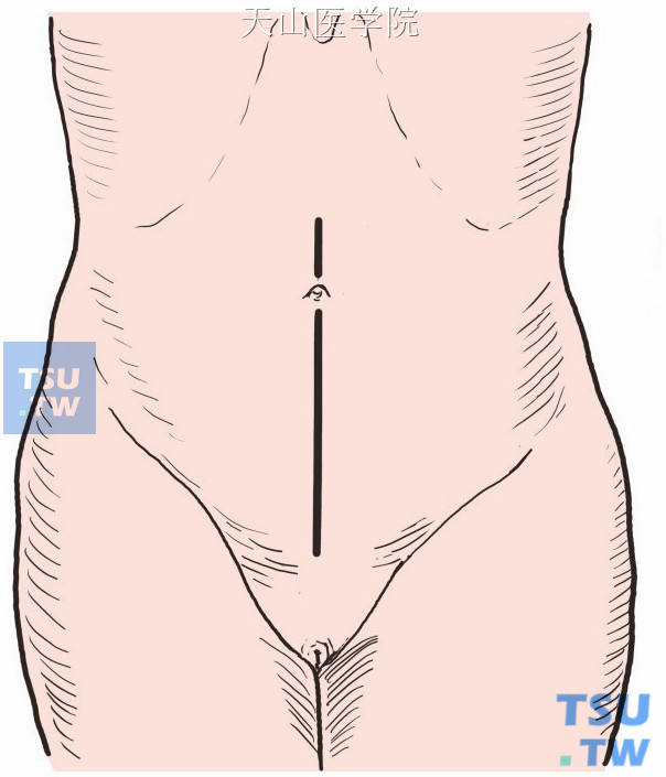 取下腹正中切口，自耻骨联合至脐上4cm