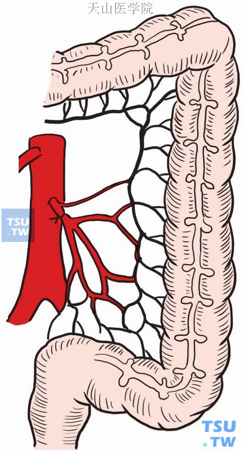 在肠系膜下动脉根部离断血管示意图