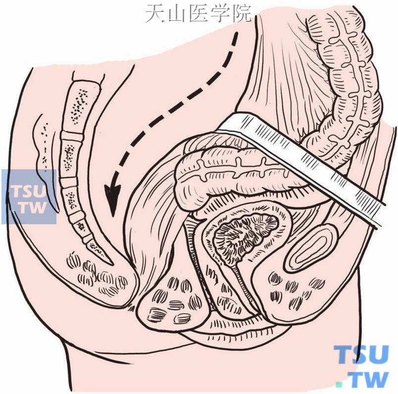 直肠前切除低位或超低位吻合术