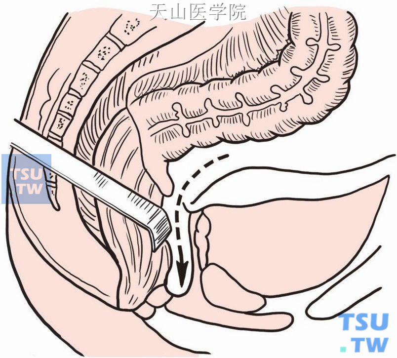 切开直肠膀胱陷凹腹膜，游离直肠前壁至肿瘤下2～3cm