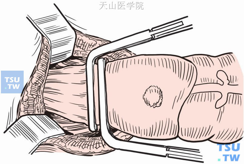 肿瘤下缘置直角钳阻断直肠